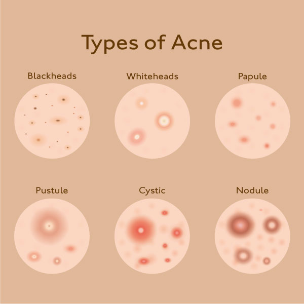 types of pimples and acne