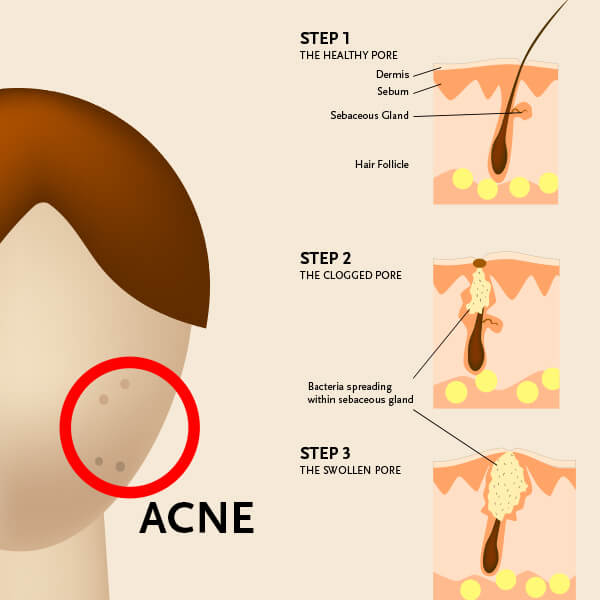  acne caused by bacteria